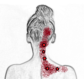headache from trigger points in the trapezius