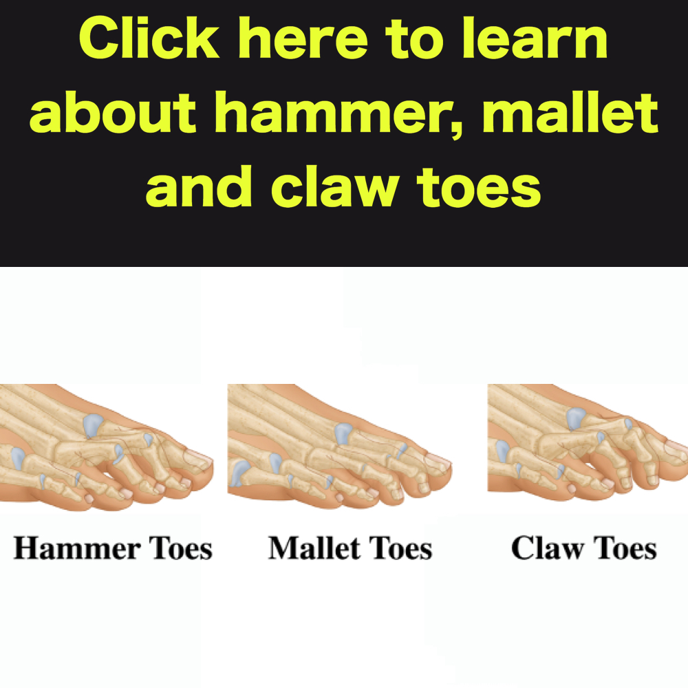 hammer mallet and claw toes