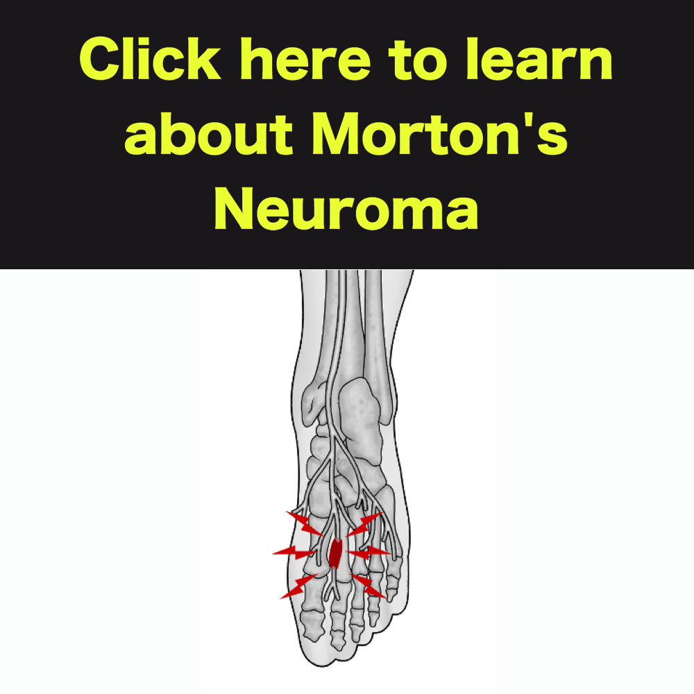 MORTON'S neuroma