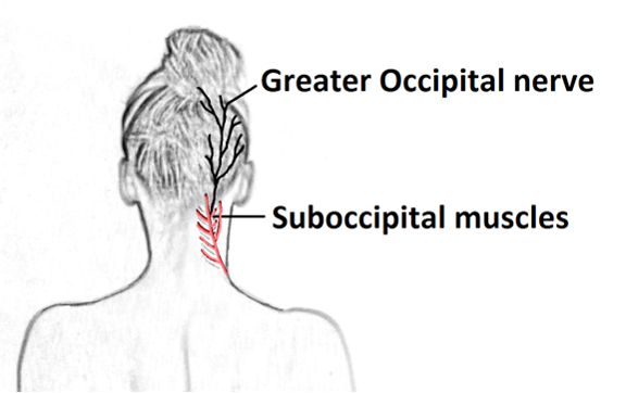 greater occipital nerve causing headaches migraine chiropractor