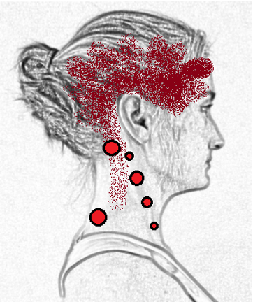 Headache from trigger point migraine chiropractor