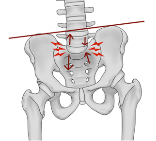 Tilted pelvis from a leg length discrepency