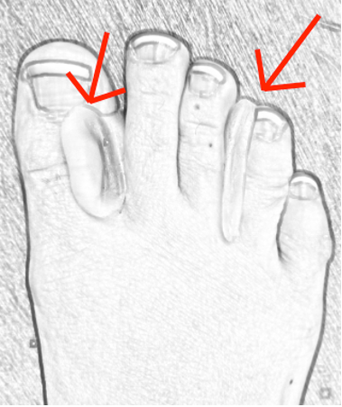 toe spacers